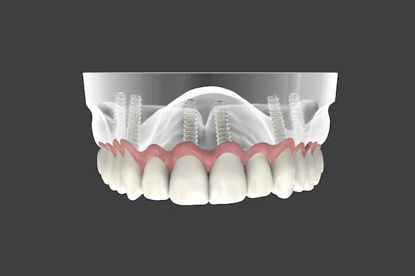 Are Implant Supported Dentures Permanent from Midtown Dental - The Gallery of Smiles in Houston, TX