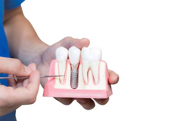 Can You Get Dental Implants if You Have Gum Disease from Midtown Dental - The Gallery of Smiles in Houston, TX