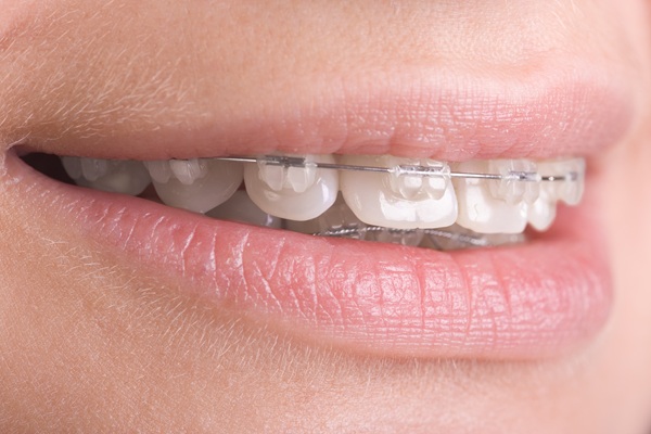 FAQs About Clear Braces Treatment