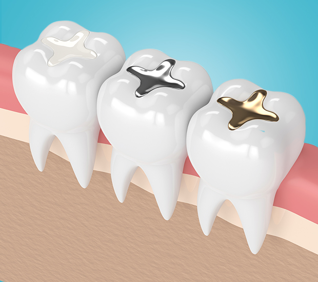 Houston Composite Fillings