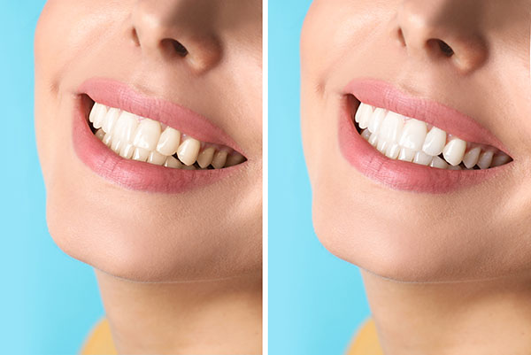 Cosmetic Dental Services With Natural Tooth Color from Midtown Dental - The Gallery of Smiles in Houston, TX