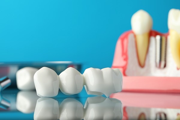 What Is A Dental Bridge?