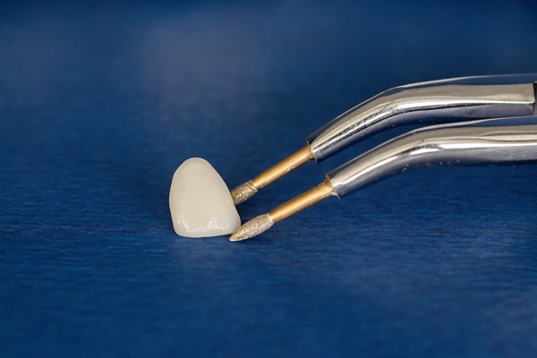 Dental Crowns: Their Purpose, Process, And Longevity