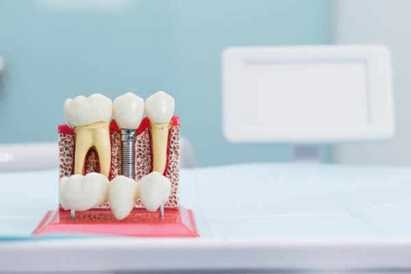 An Overview Of Implant Dentistry Treatment