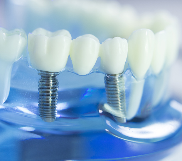 Houston Dental Implants