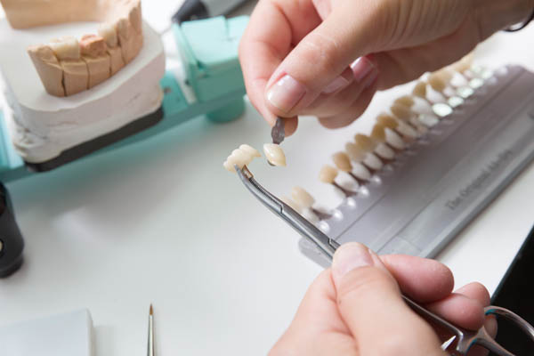 Questions To Ask A Dentist About Dental Veneers