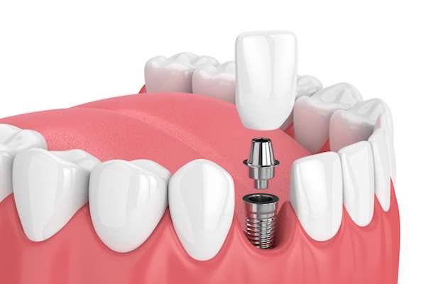How Painful is Dental Implant Surgery from Midtown Dental - The Gallery of Smiles in Houston, TX