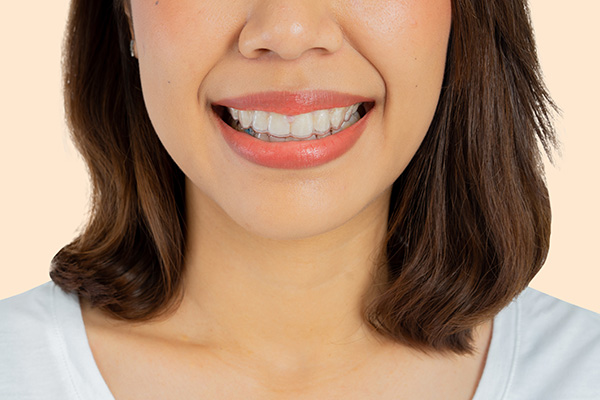 Invisalign Teeth Straightening is More Comfortable than Braces from Midtown Dental - The Gallery of Smiles in Houston, TX