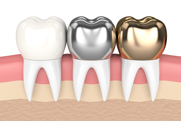 Metal Crowns vs. Porcelain Dental Crowns from Midtown Dental - The Gallery of Smiles in Houston, TX