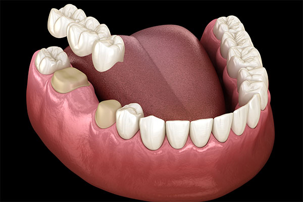 When a Dental Bridge Is a Cosmetic Dental Services Option from Midtown Dental - The Gallery of Smiles in Houston, TX